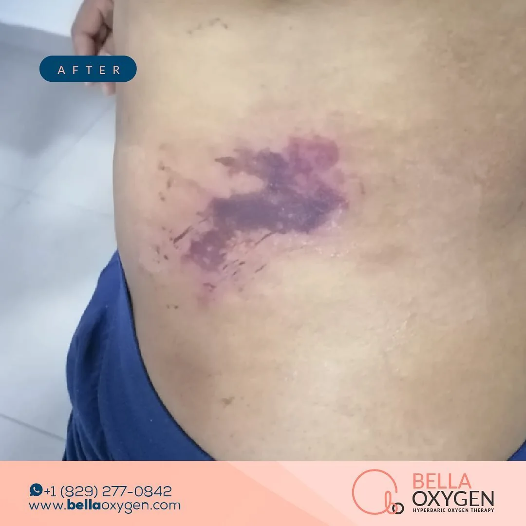 After photo showing the same hip and abdomen area following the clinic-reported recovery period