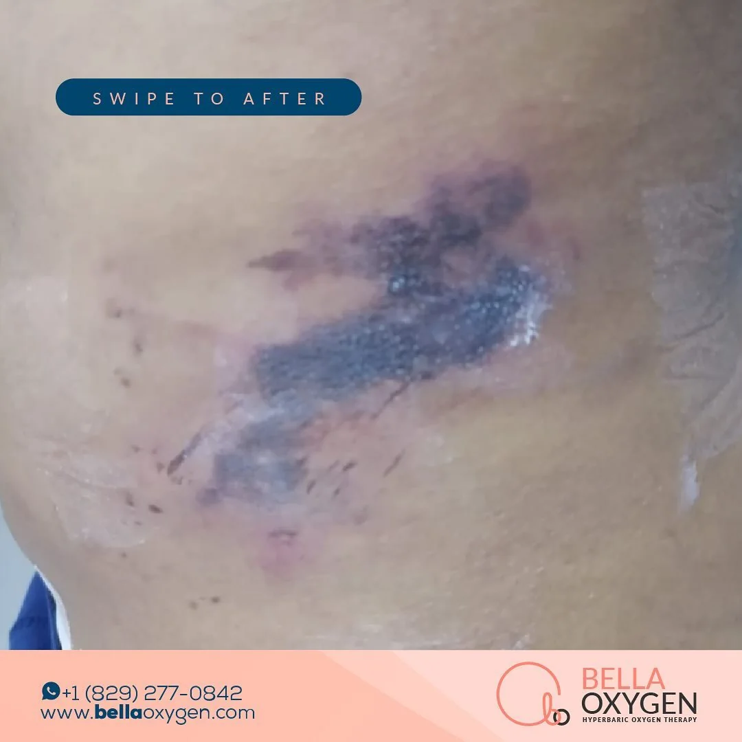 Before photo showing bruising around the hip and abdomen prior to a reported series of hyperbaric sessions