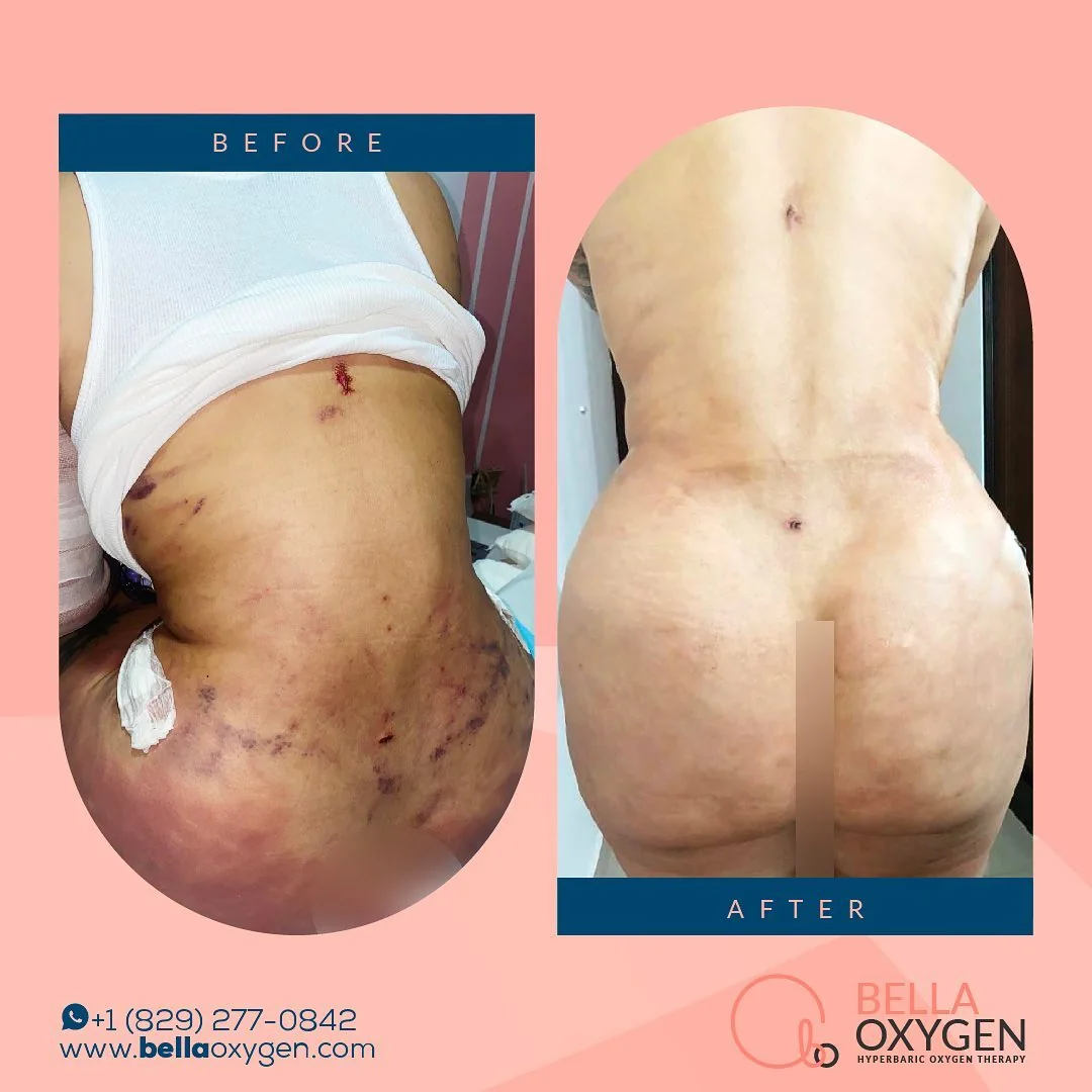 Side-by-side Bella Oxygen before-and-after comparison of back and buttock bruising and later healing