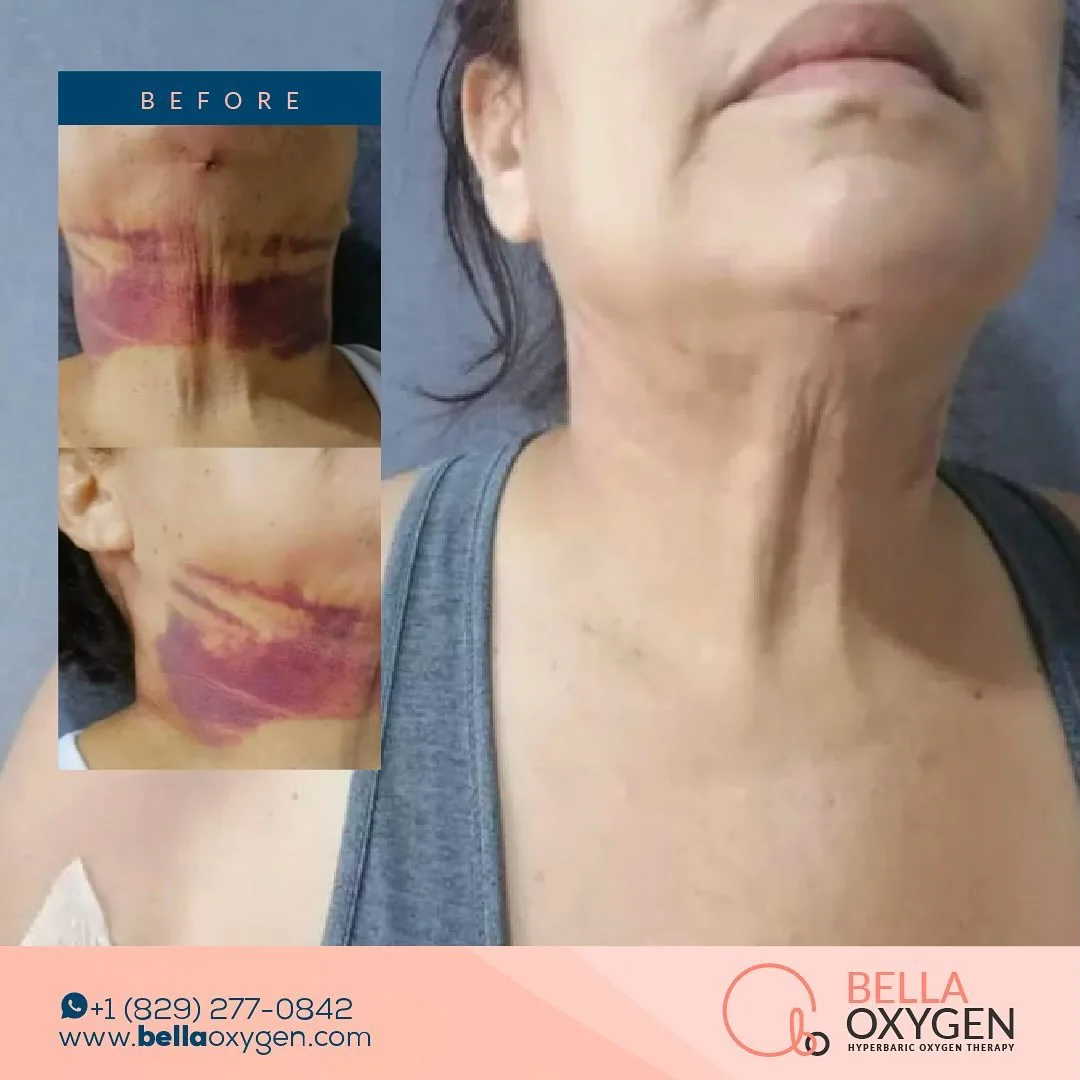 Bella Oxygen before-and-after comparison showing neck and chin bruising and later improvement