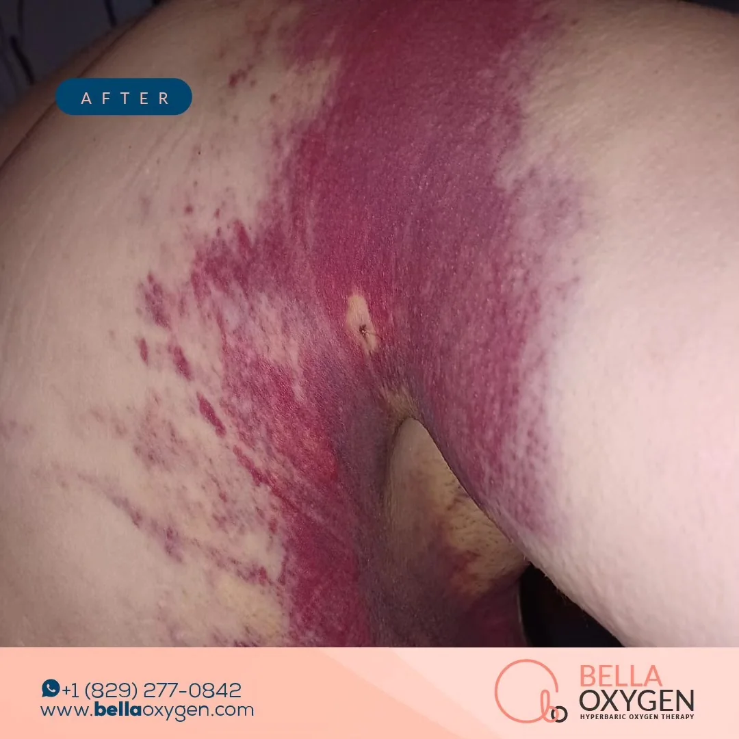 After photo showing the same abdomen and torso area later in recovery