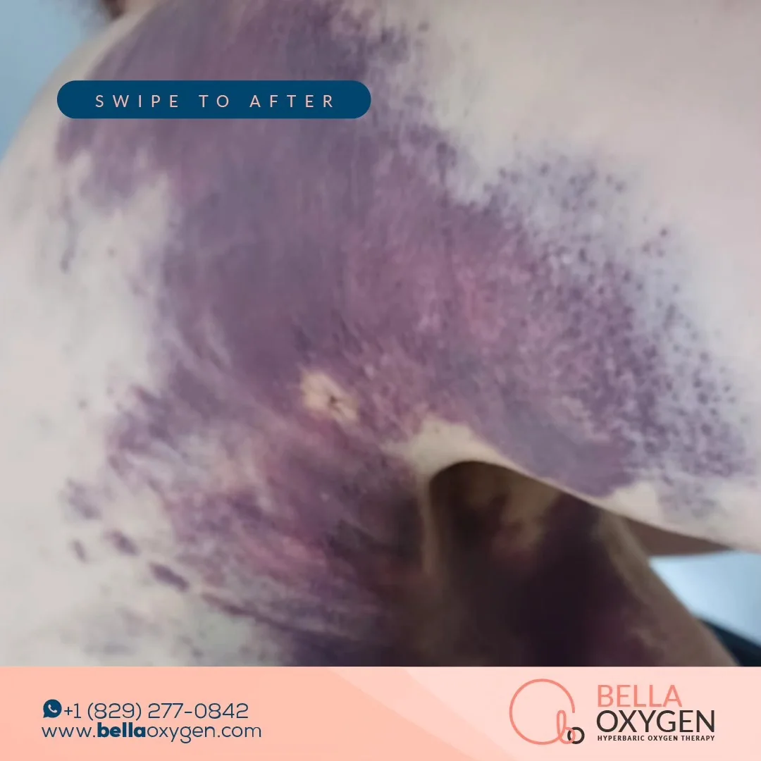 Before photo showing pronounced purple bruising across the abdomen and torso